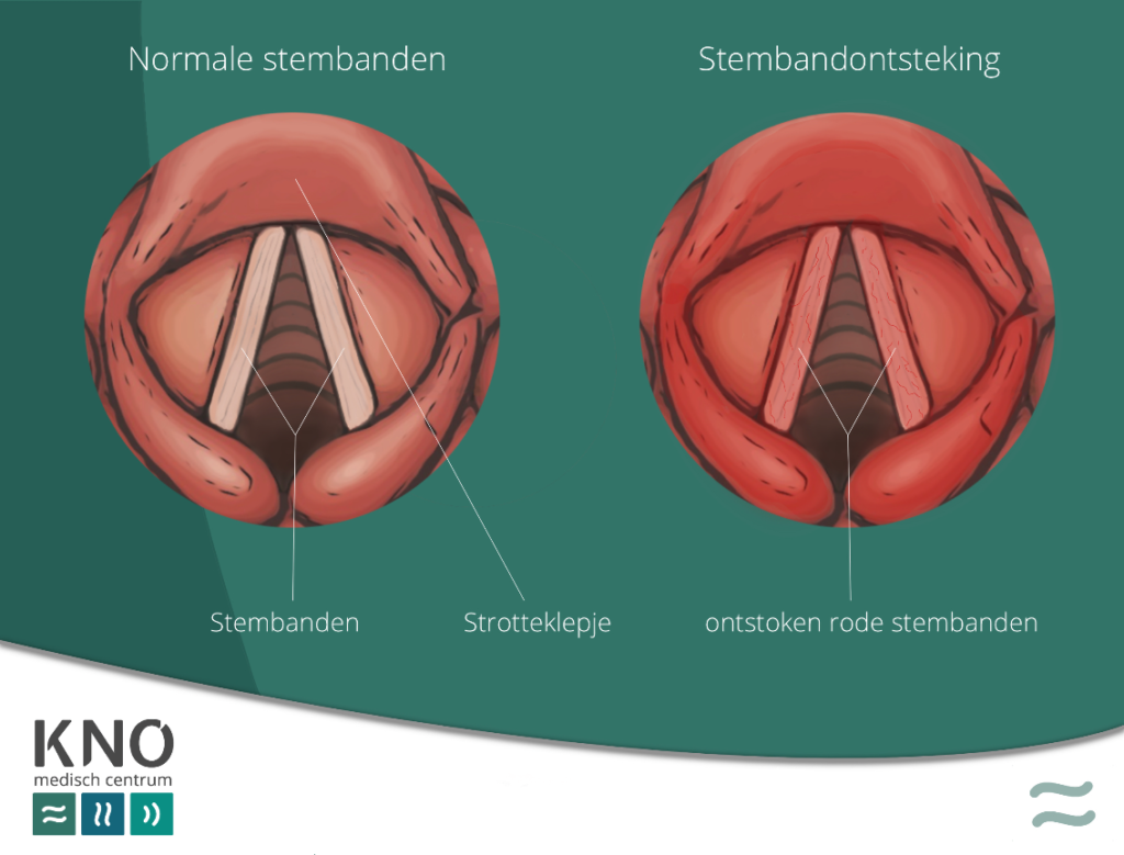 ontstoken stembanden (laryngitis)