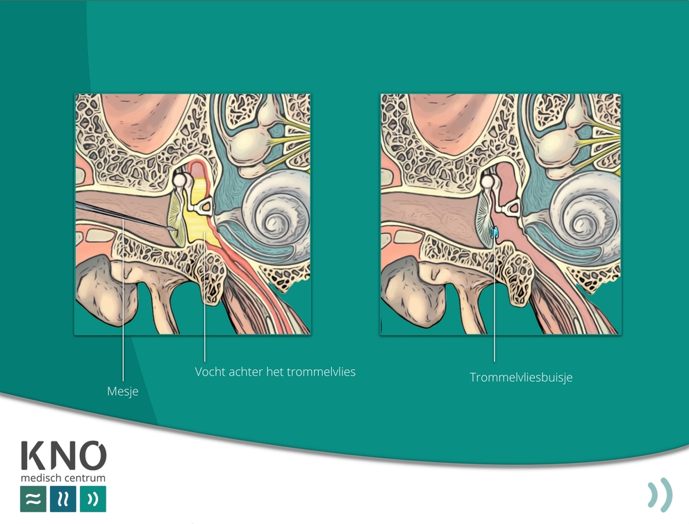 vocht achter het trommelvlies