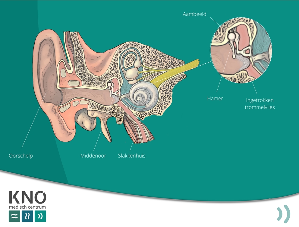 fors ingetrokken trommelvlies