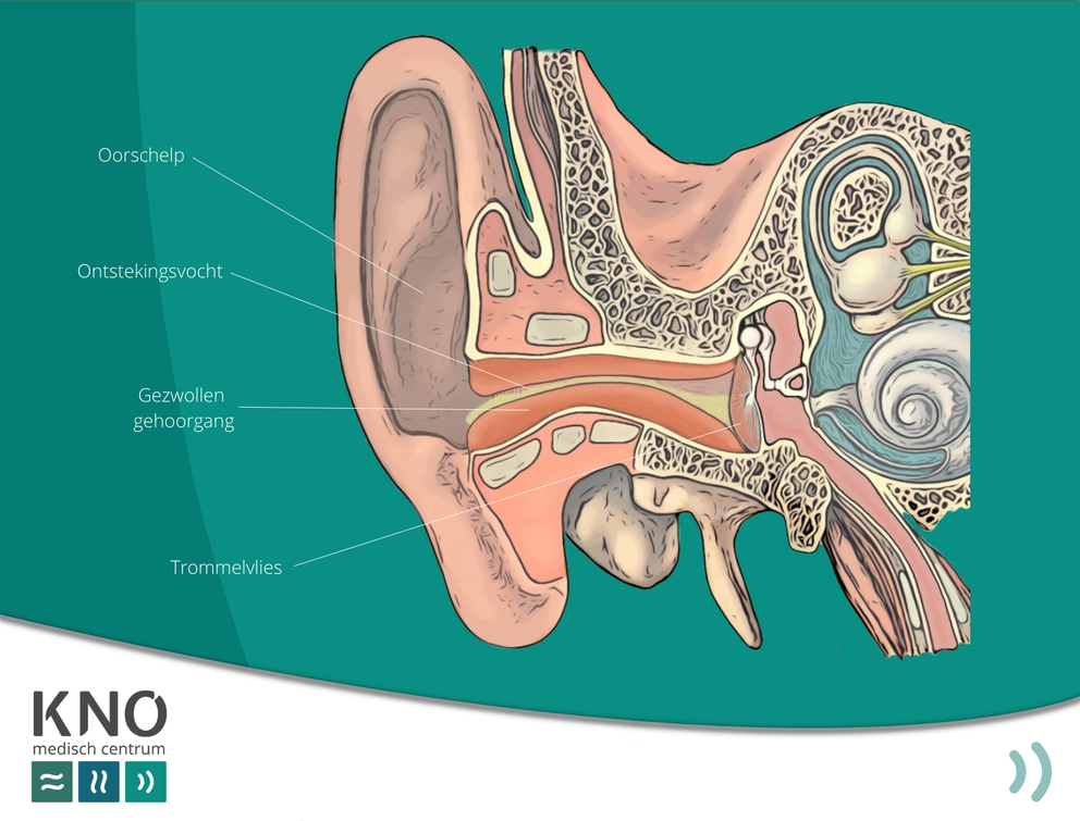 gehoorgangontsteking (otitis externa)