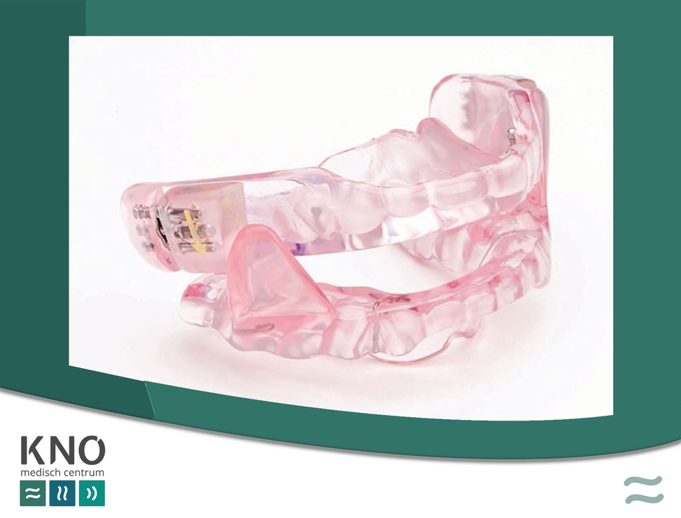 MRA (mandibulair Repositie Apparaat)