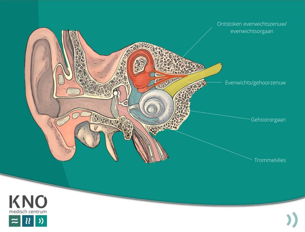 neuritis vestibularis