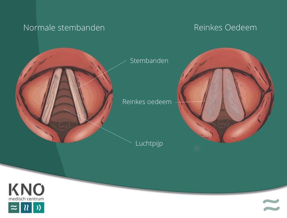KNO Medisch Centrum Reinkes oedeem