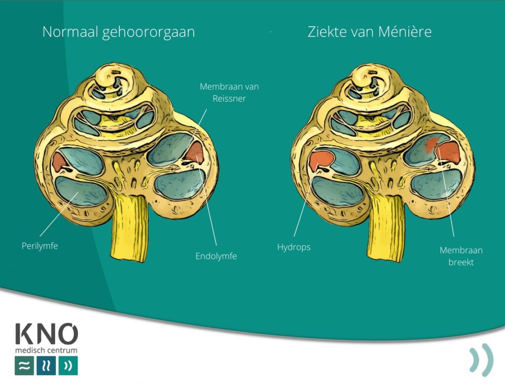 Ziekte van Ménière