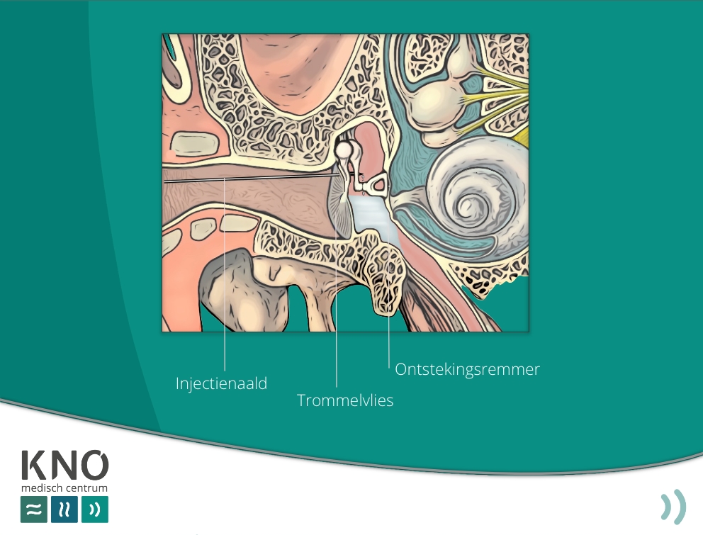 injectie in het middenoor