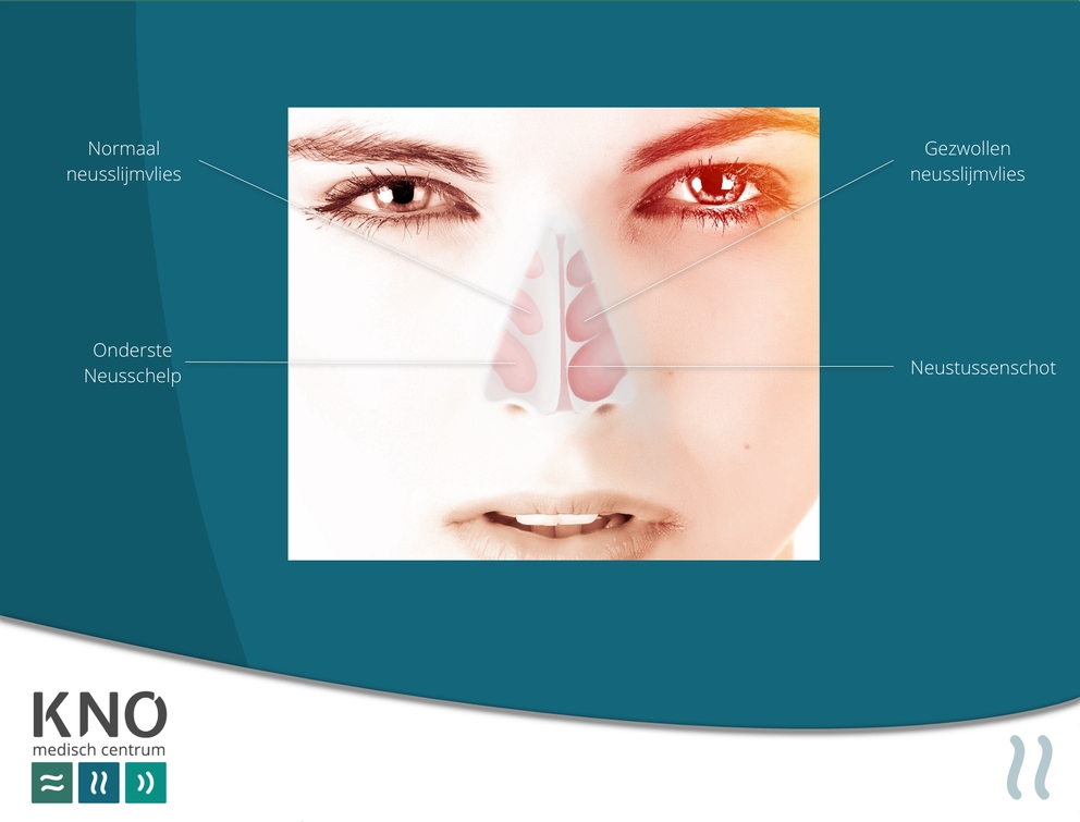 allergische rhinitis 