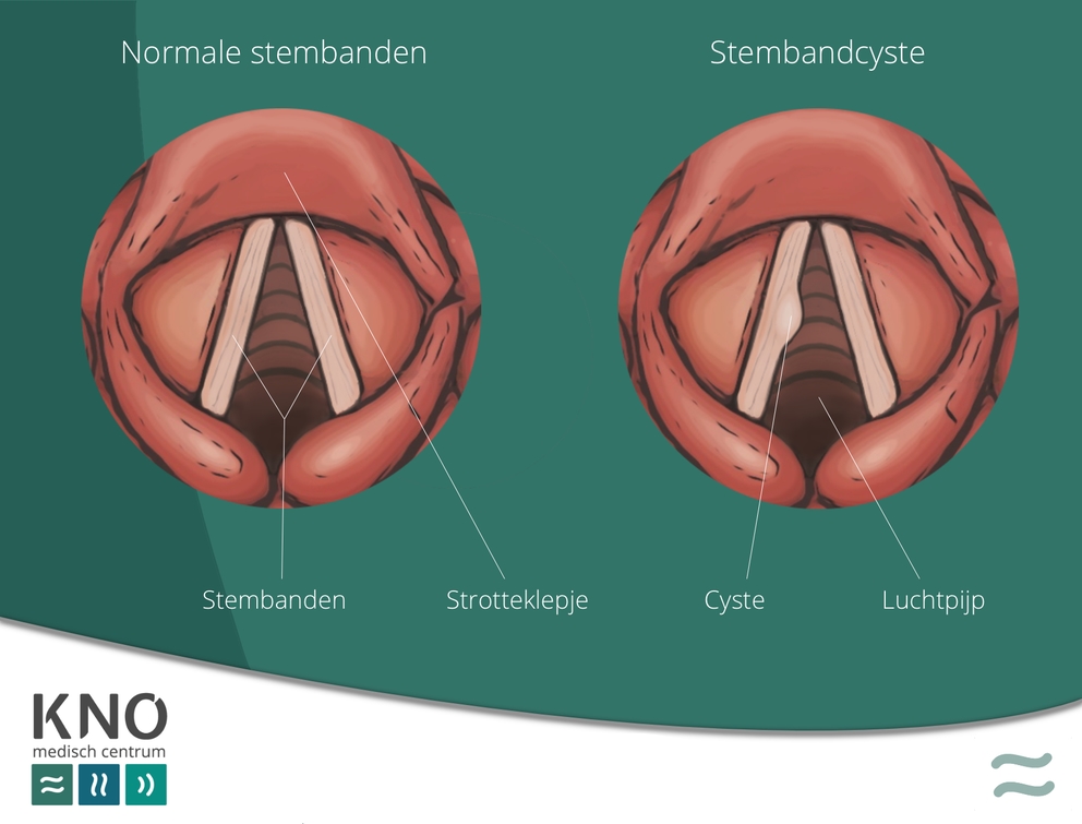 stembandcyste