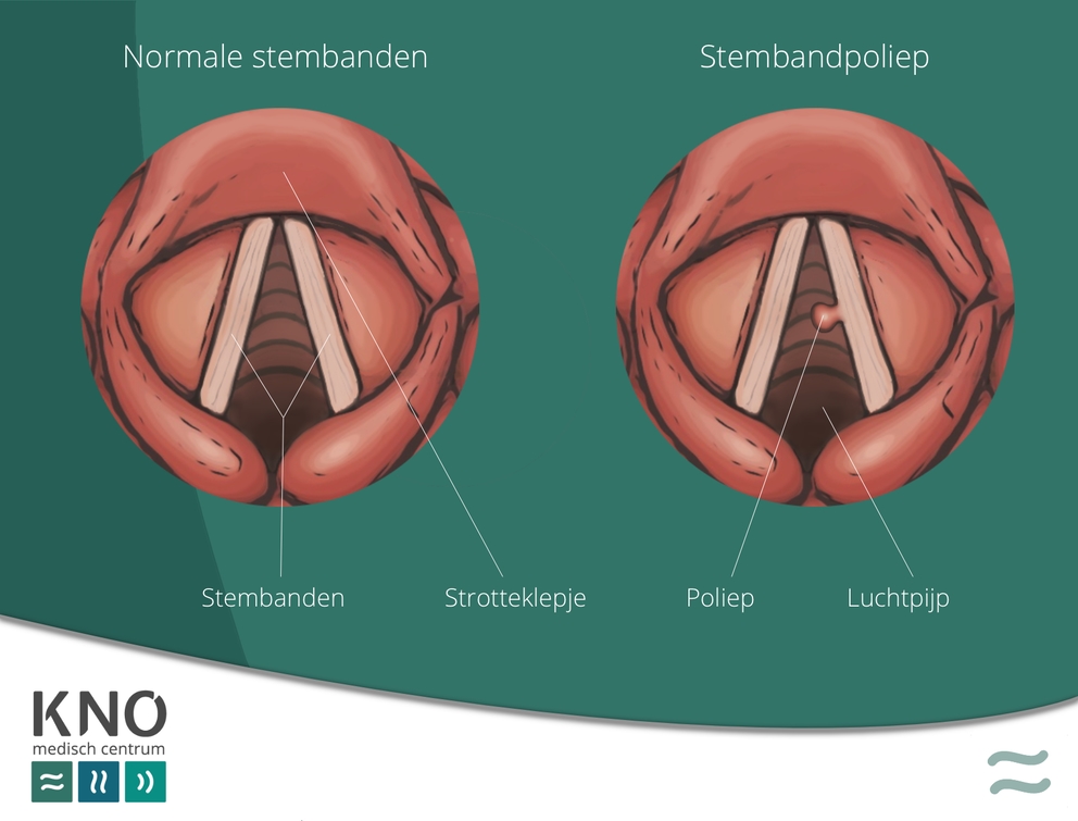stembandpoliep