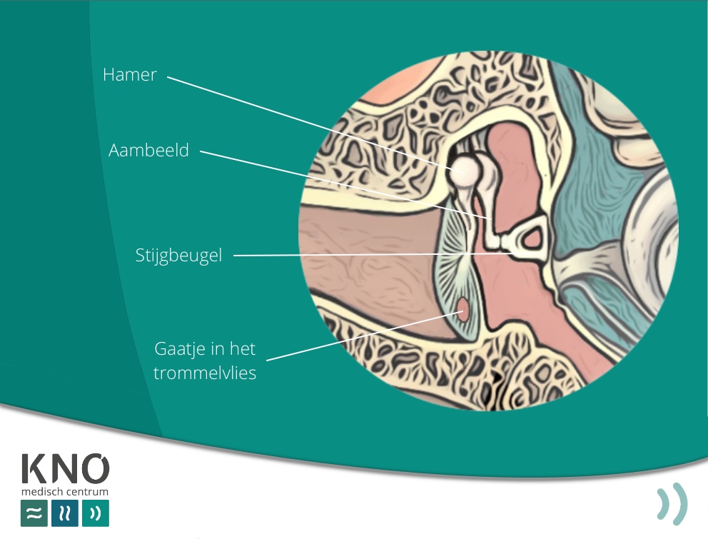 trommelvlies perforatie