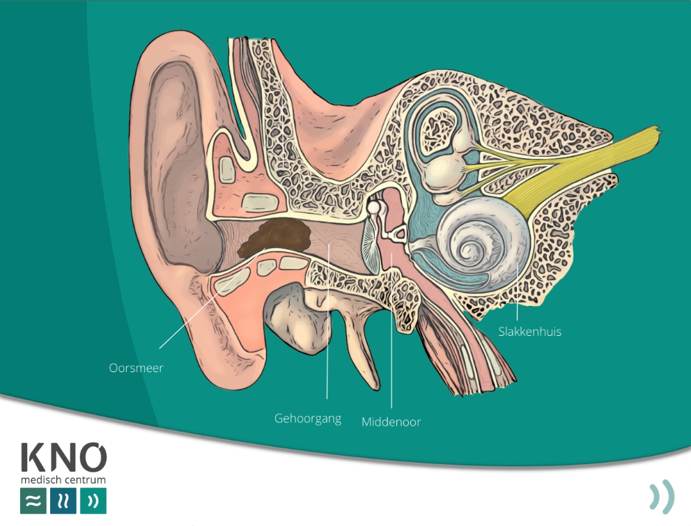 veel oorsmeer (cerumen)