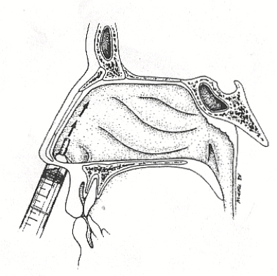 neusspoelen met een spuitje