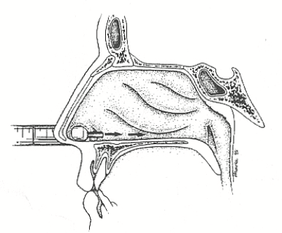 neusspoelen met een spuitje