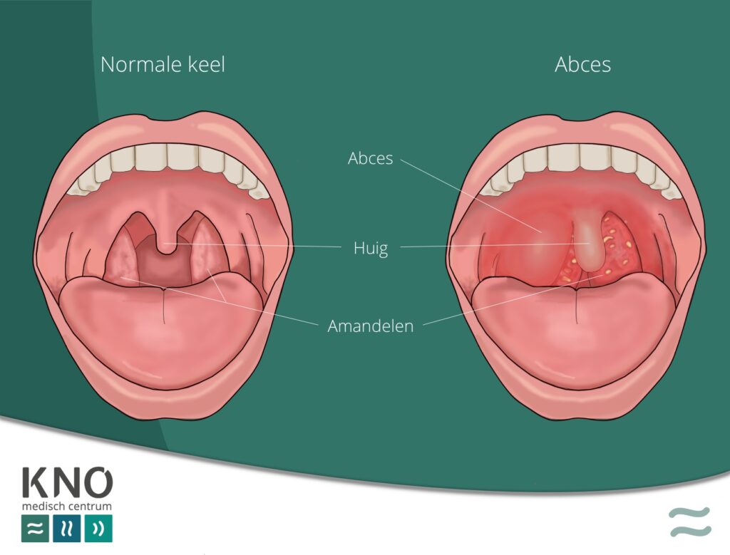keelabces (peritonsillair abces)